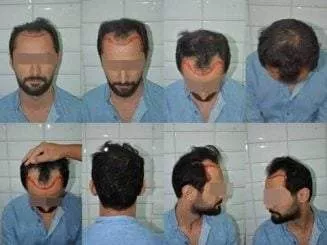 before hair transplantation