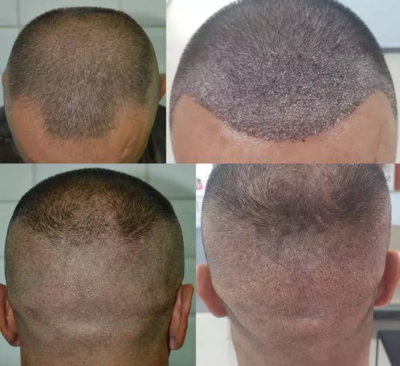 1st day after hair transplantation