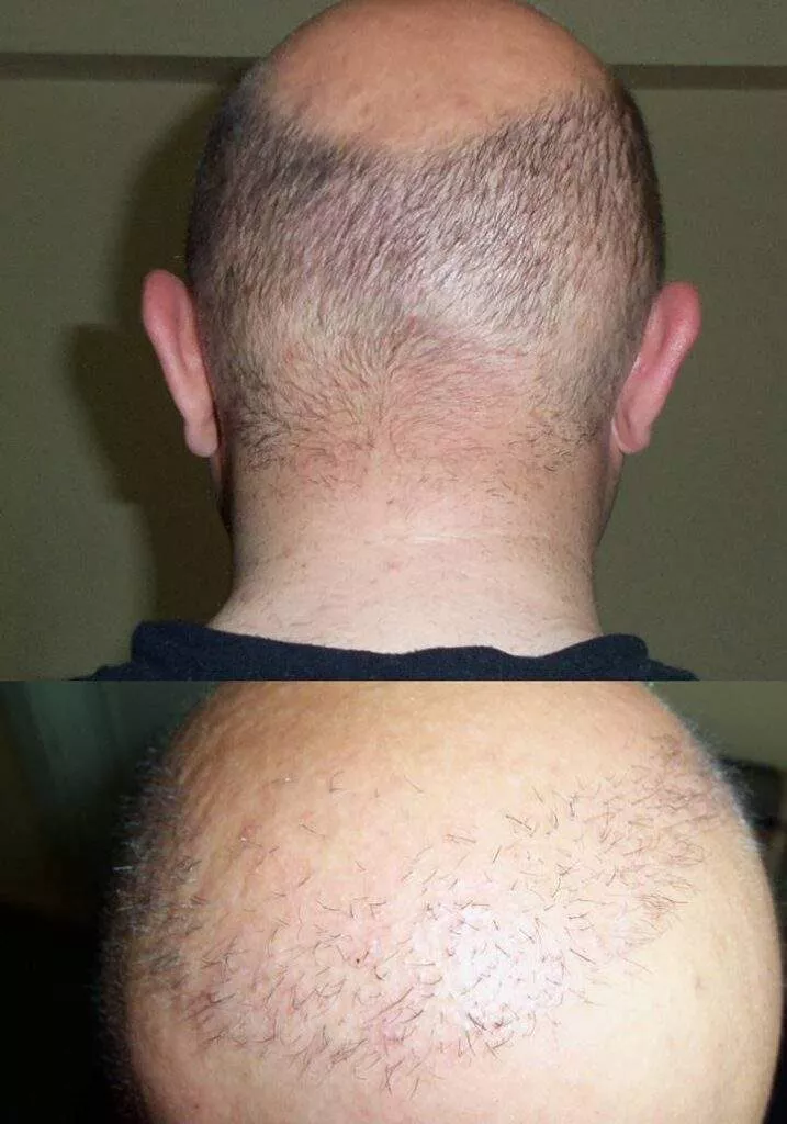 hair transplant result