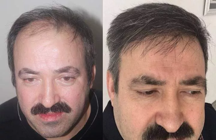 hair transplant results