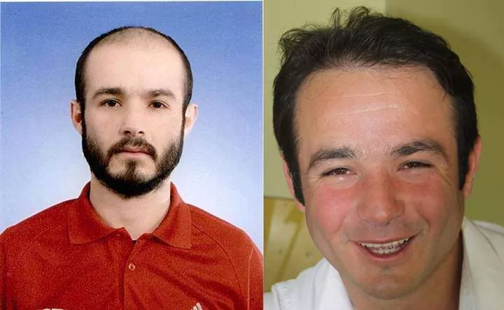 hair transplant result