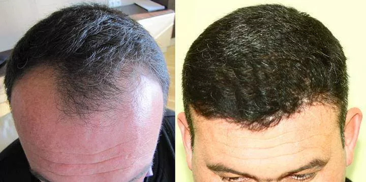 hair transplant results