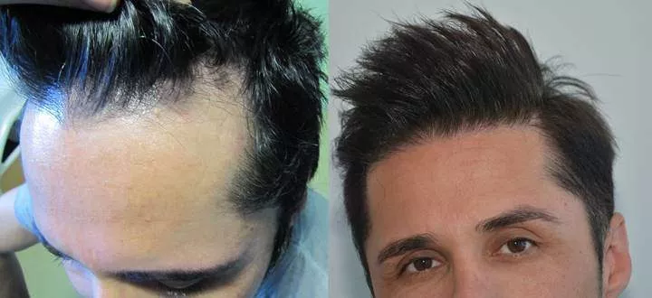 hair transplant results