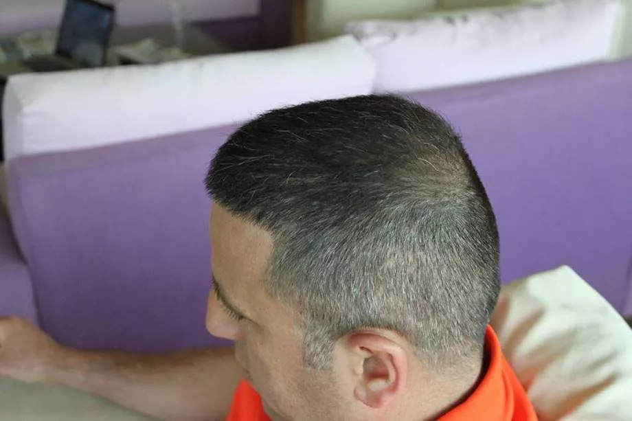 after hair restoration