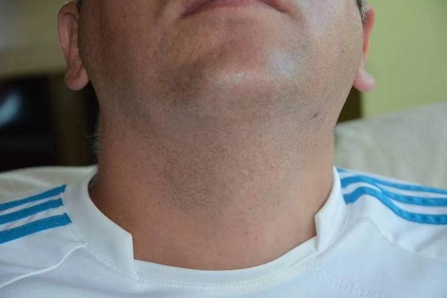 after hair transplant beard area