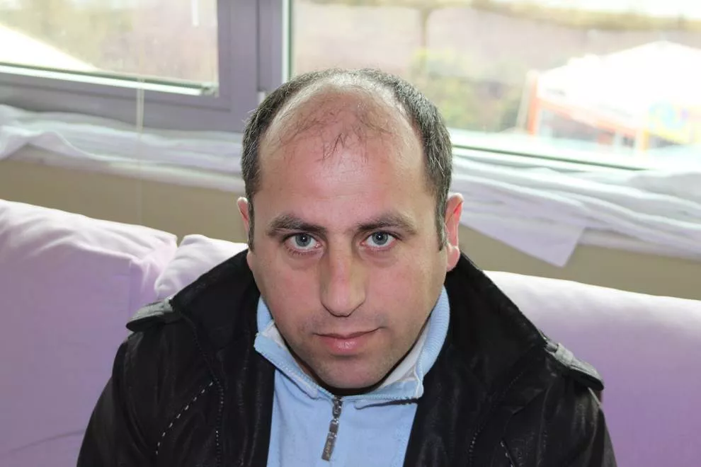 before hair transplant
