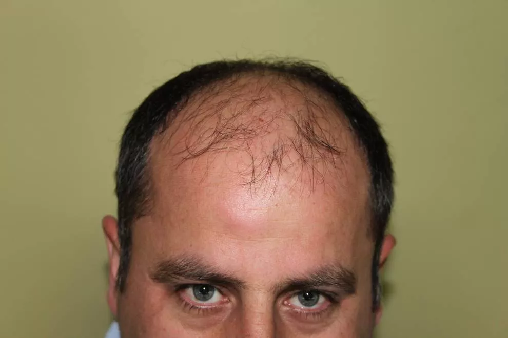 before hair transplantation