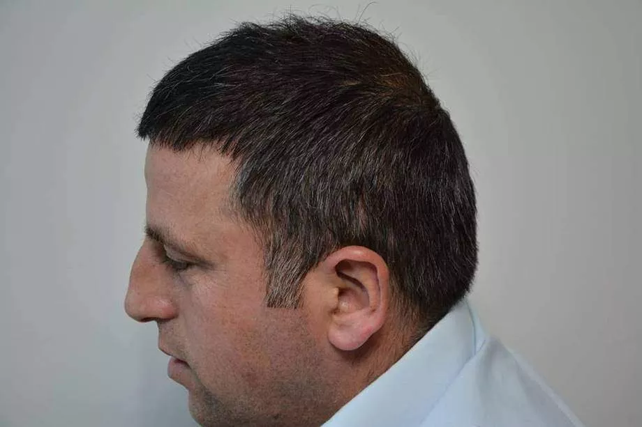 hair implant 1 year