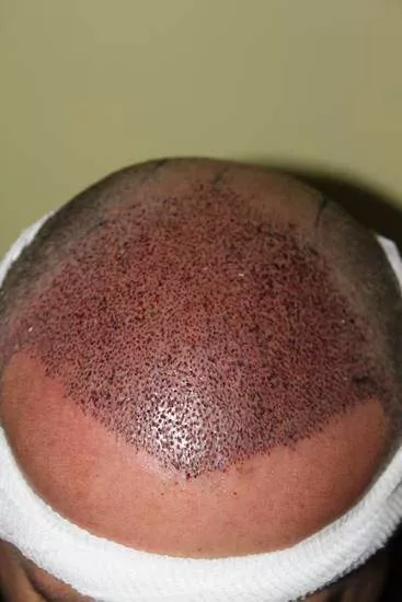 hair transplant1 day