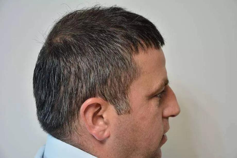 hair implantation 1 year right side