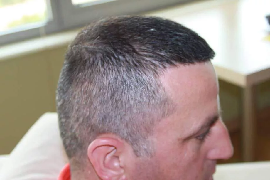 hair implant after donor area