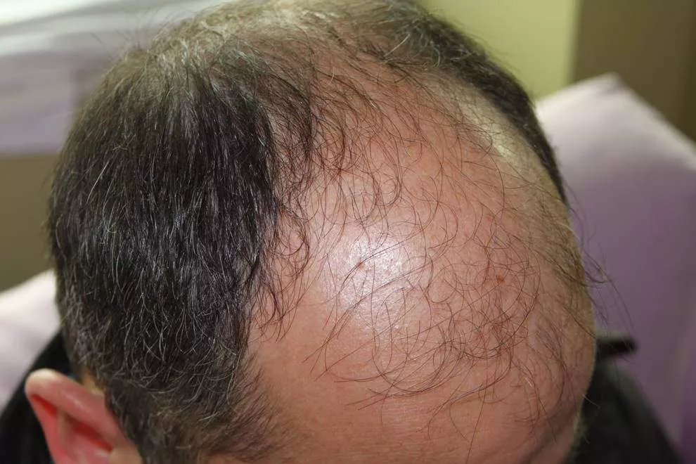 hair restoration before
