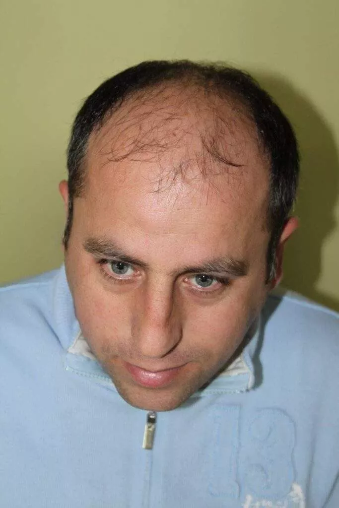 hair transplantation 10000 grafts before