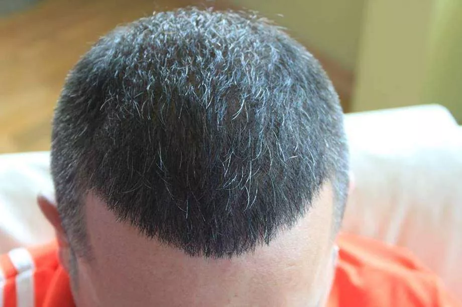 after hair transplant 2 years
