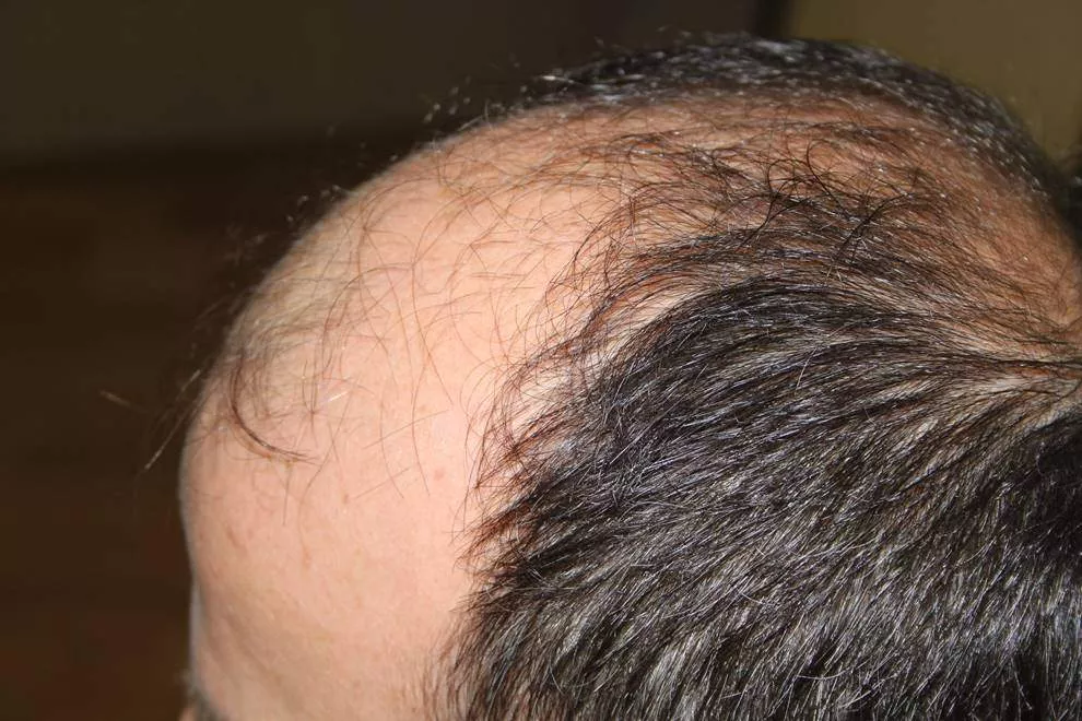 hair transplant before left