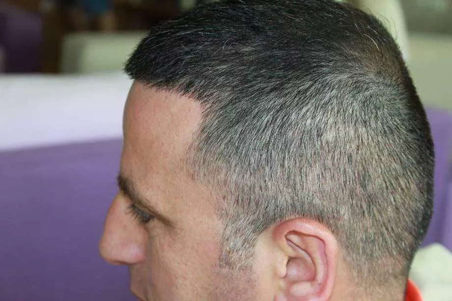 hair transplant donor area 1 year