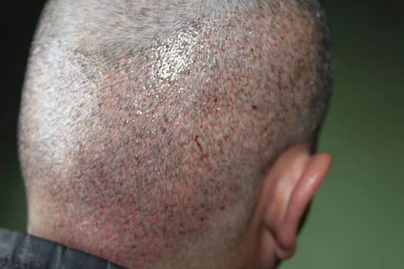 hair transplant donor area 3.days
