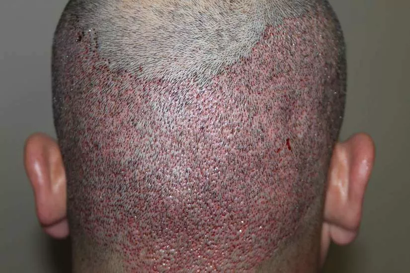 hair transplant donor area day2