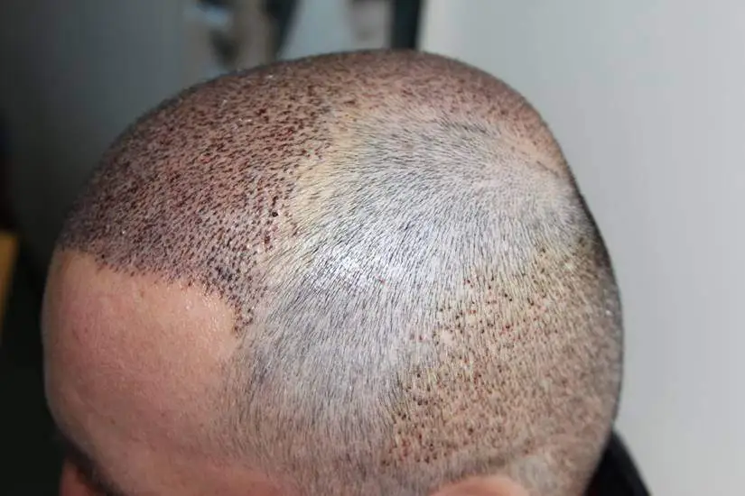 hair transplant first day