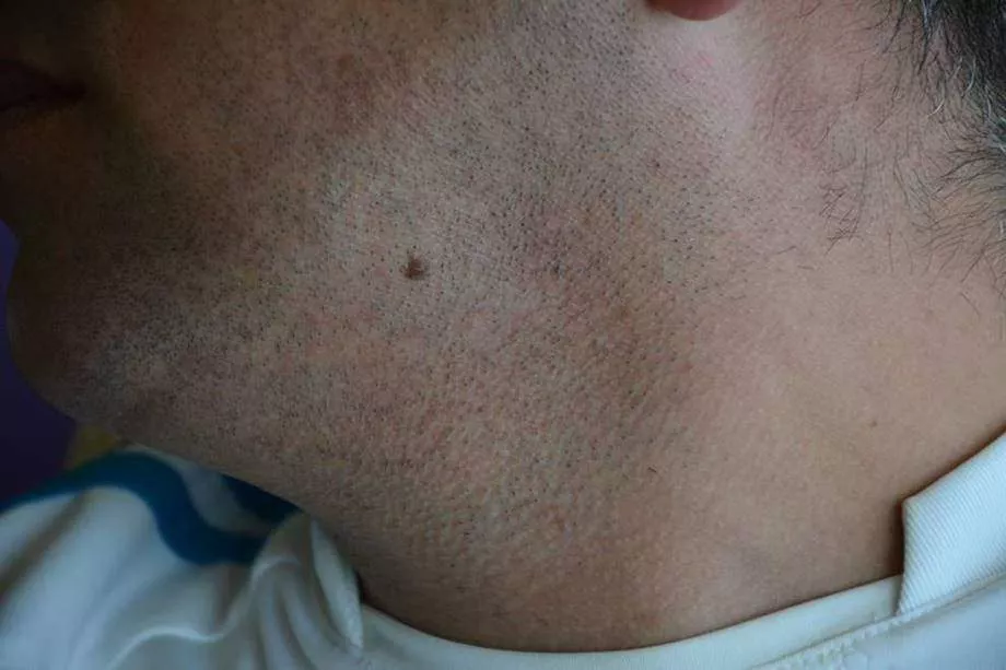 hair transplant from beard after 1 year