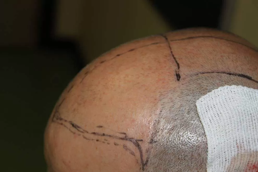 hair transplant left side