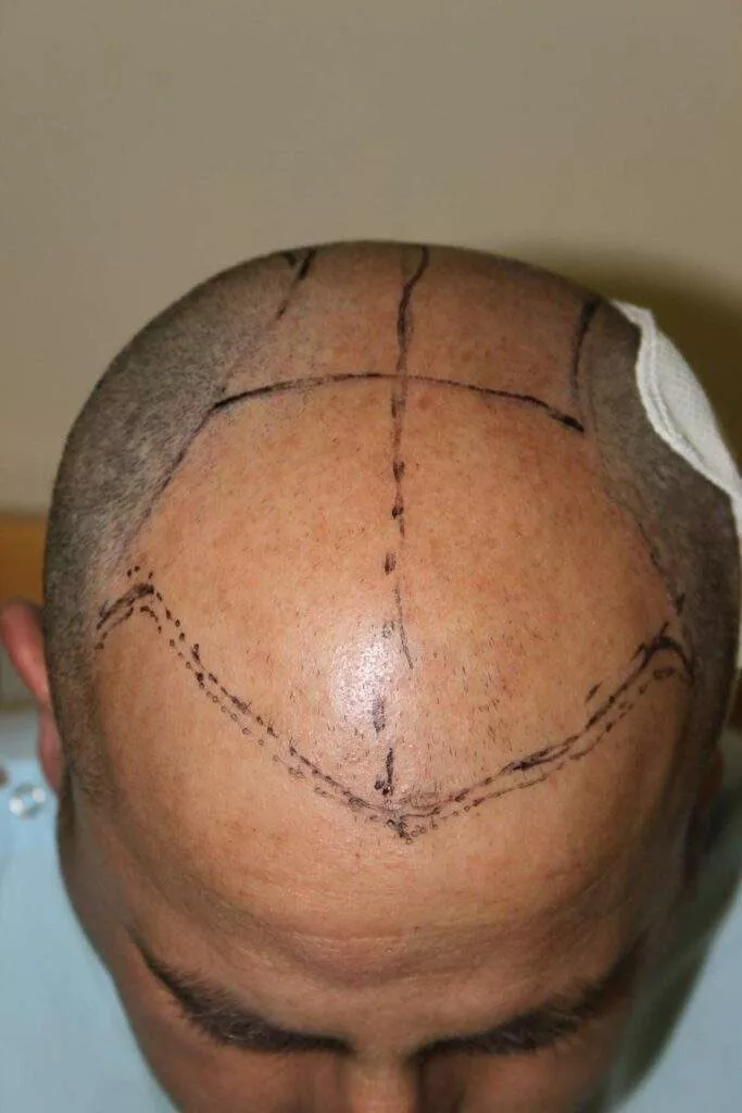 hair transplant procedure