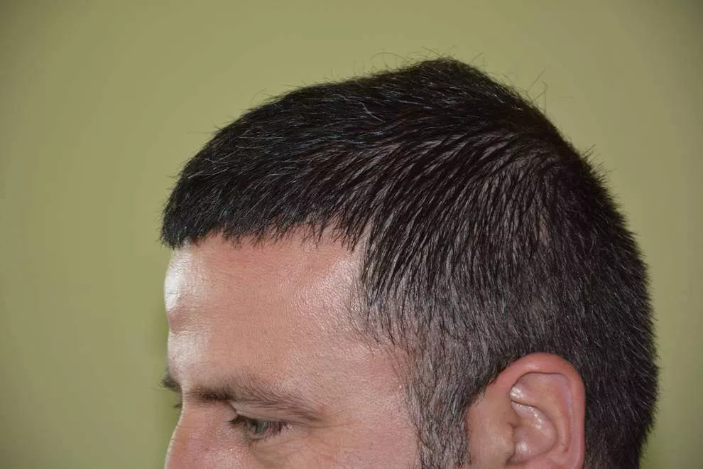 hair transplant after left side