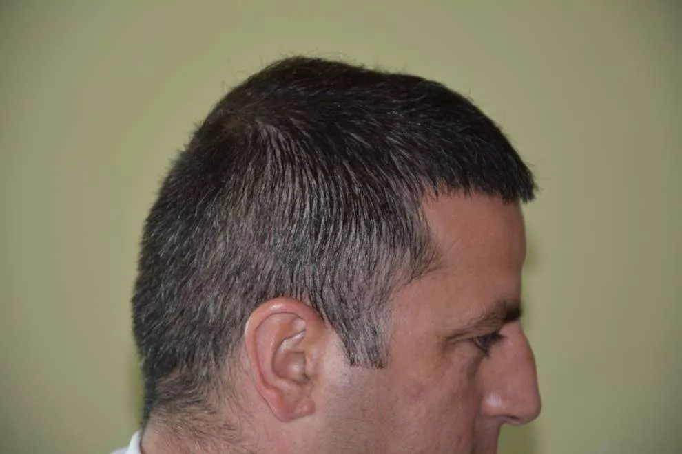 hair transplantation left side