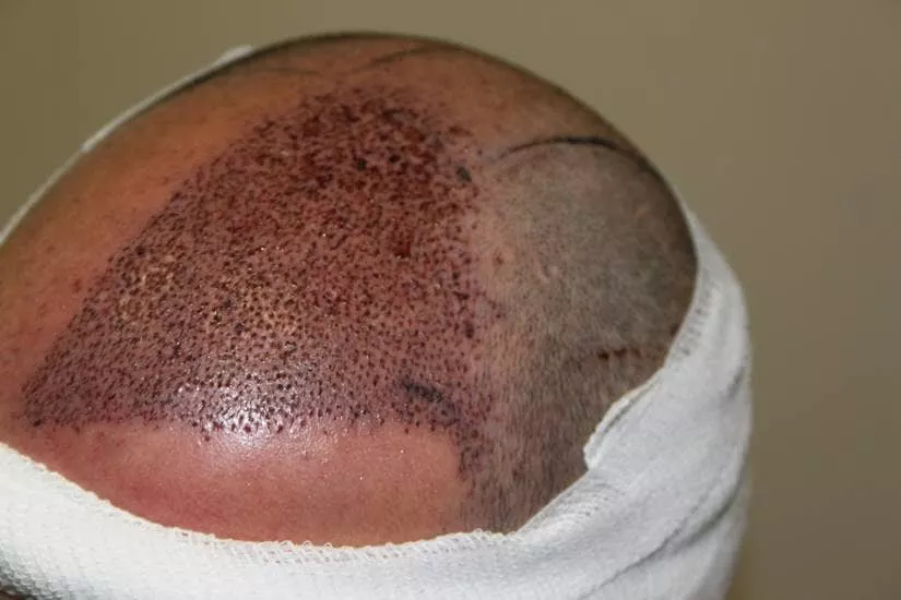 hair restoration day 1