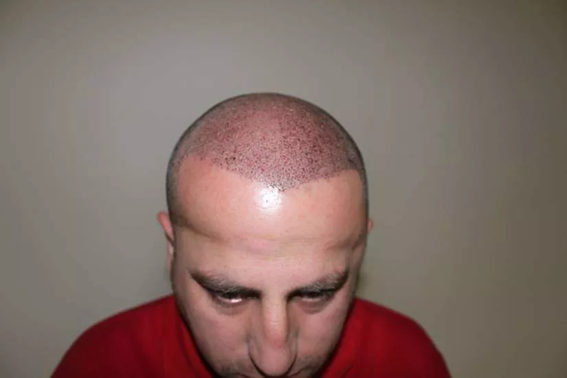 hair transplant swelling 3 days