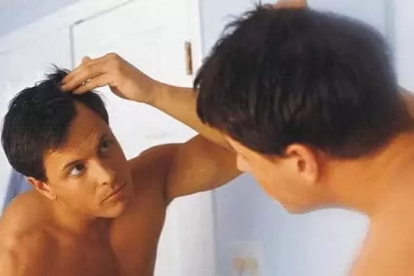avant greffe de cheveux