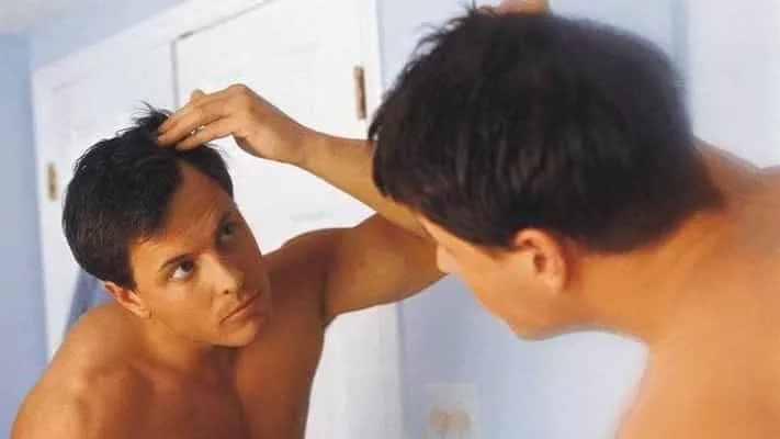 avant greffe de cheveux