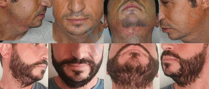 beard transplant burn