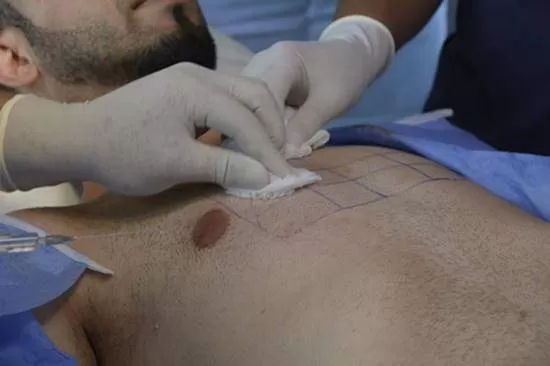 body hair transplantation