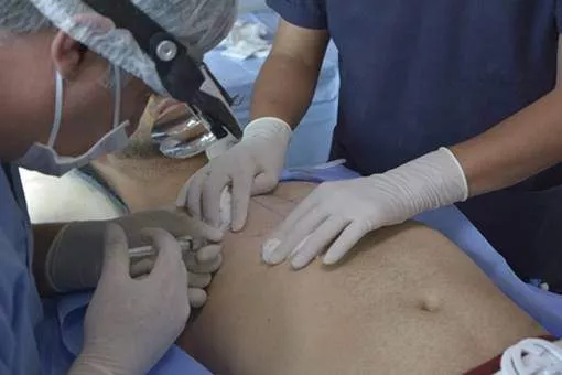chest hair transplant