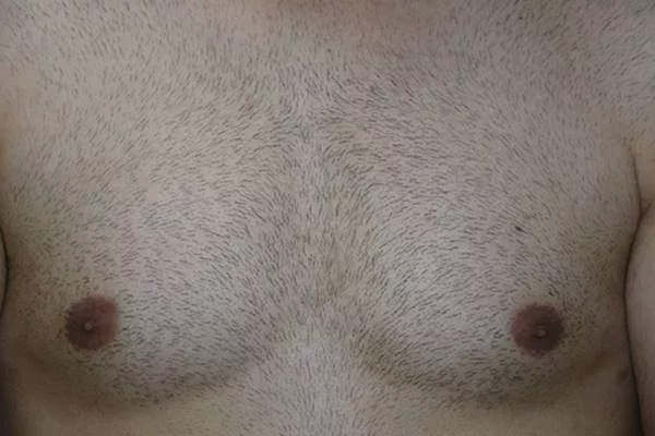 chest hair transplant
