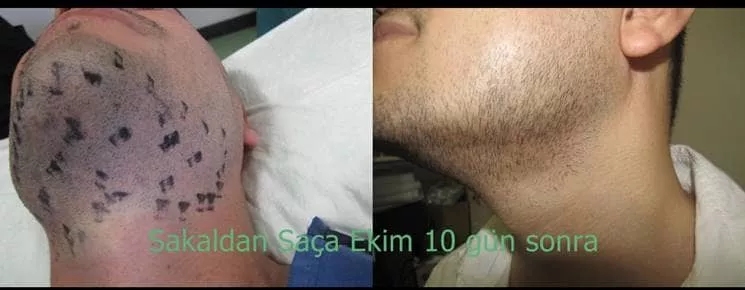 facial hair transplant