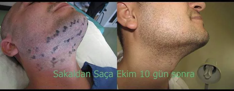 fue hair transplant from beard