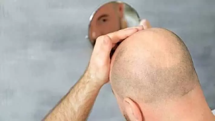 gonflement apres greffe cheveux