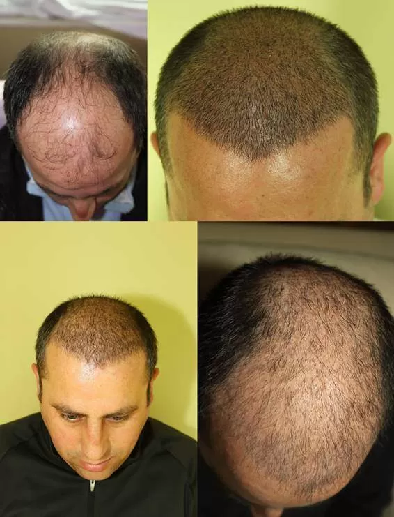 Évolution mois par mois et chute des cheveux après une greffe.