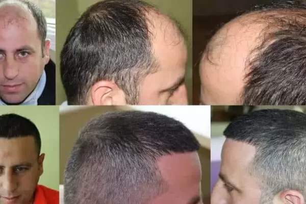 greffe de cheveux en turquie
