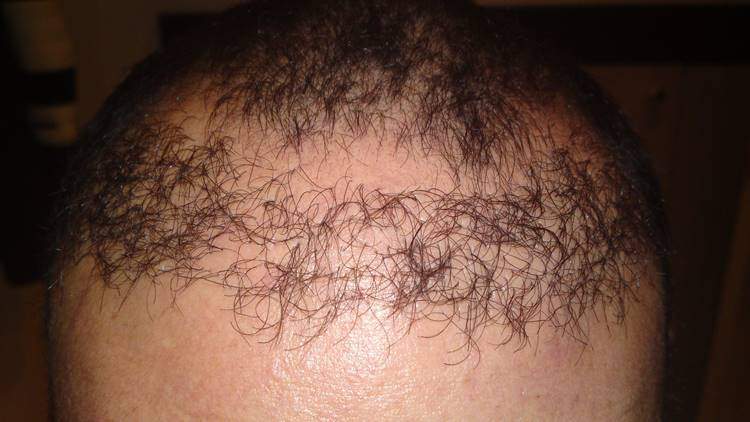 implant capillaire rate
