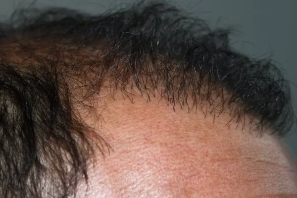 greffe de cheveux ratée