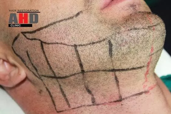 hair transplant from beard