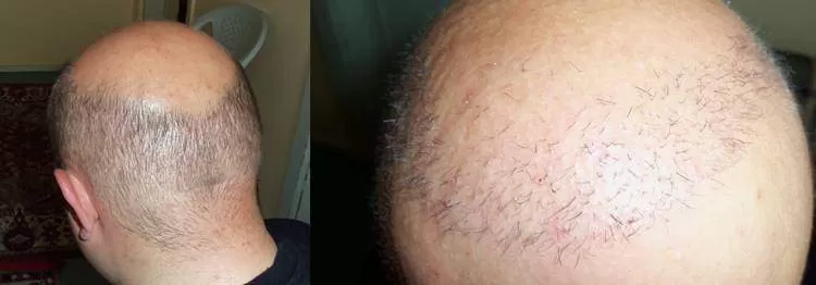 greffe de cheveux rate
