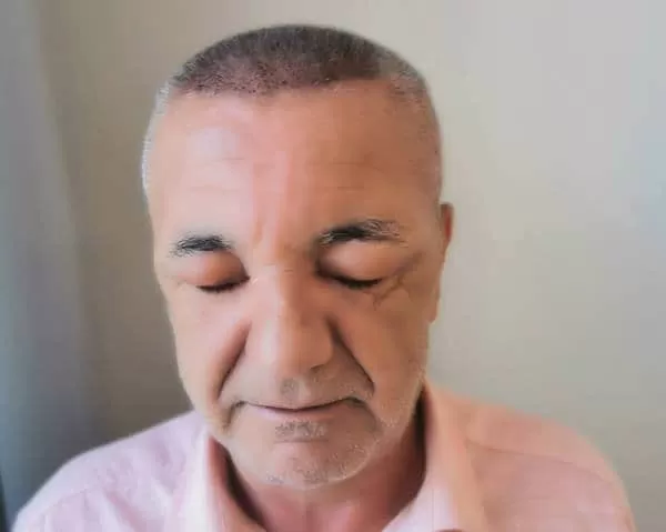 oedeme apres implant capillaire
