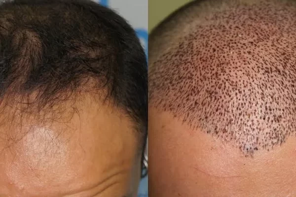 Apres Greffe de Cheveux