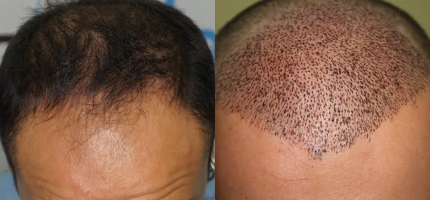Apres Greffe de Cheveux