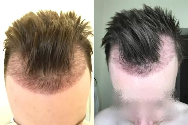 Évolution de la greffe de cheveux après 1 mois de cicatrisation.