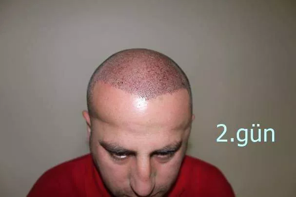 Aspect après deux jours de greffe de cheveux